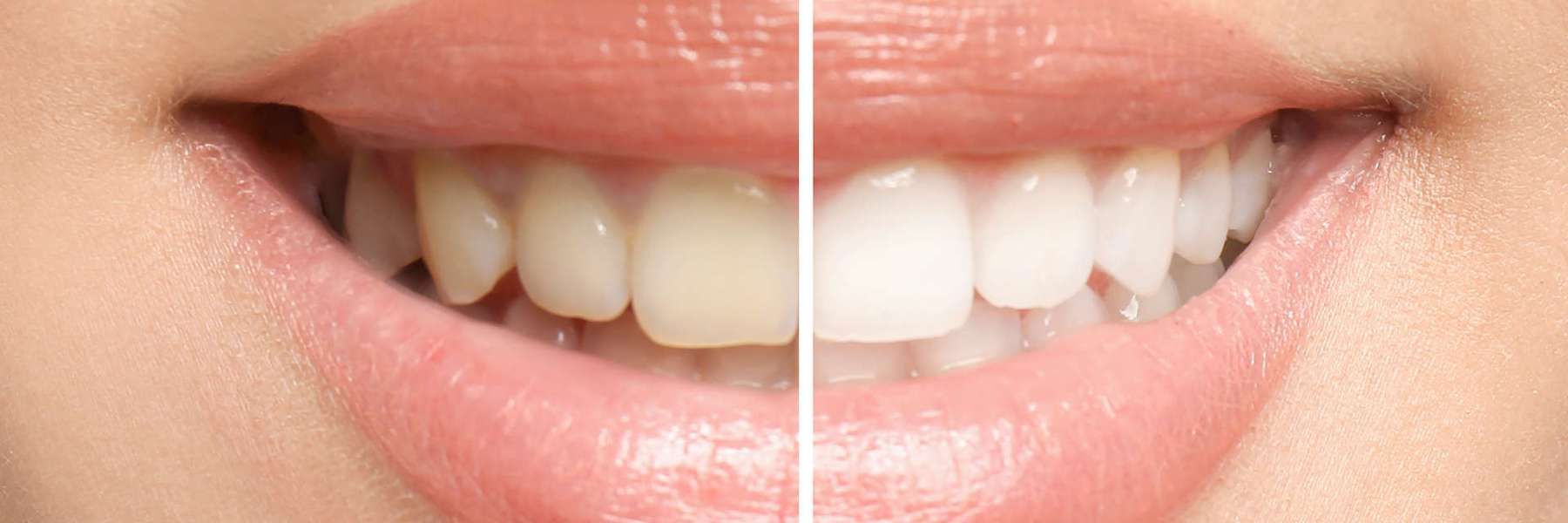 teeth whitening as part of a smile makeover in huntsville, AL