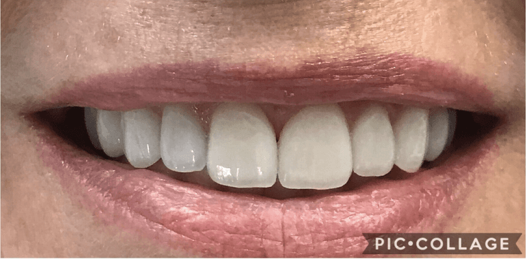 Porcelain-Veneers-Results-After-Image