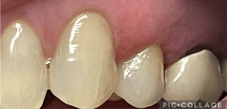 Same-Day-Crown-After-Image