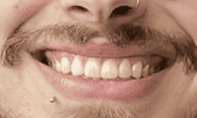 smile after veneers in huntsville, al