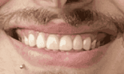 Porcelain-Veneers-After-Image