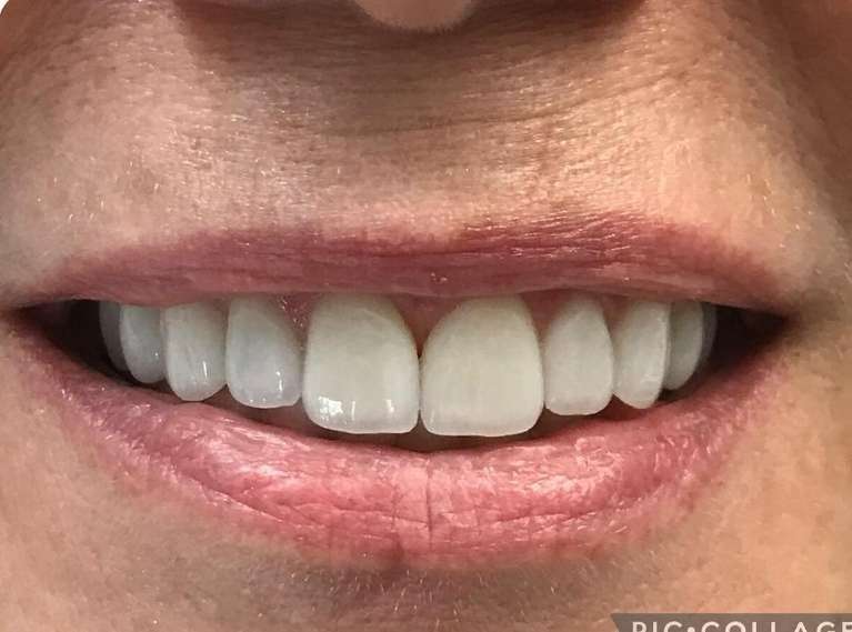 after porcelain veneers in huntsville, AL