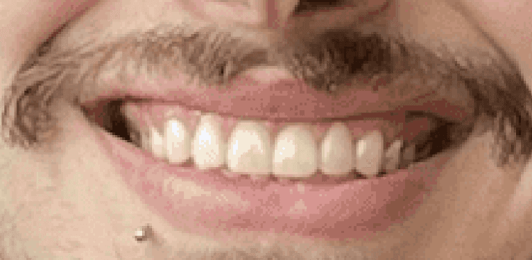 smile after veneers in huntsville, al