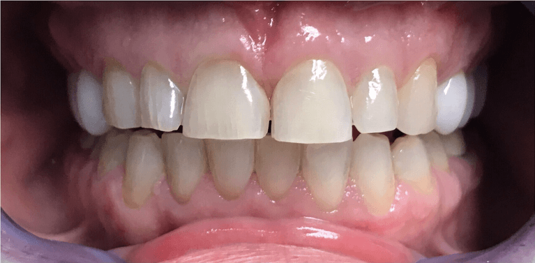 Porcelain-Veneers-Results-Before-Image
