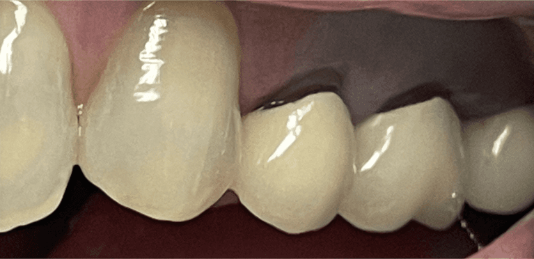 Same-Day-Crown-Before-Image