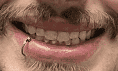 smile before veneers in huntsville, al