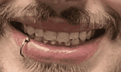 Porcelain-Veneers-Before-Image