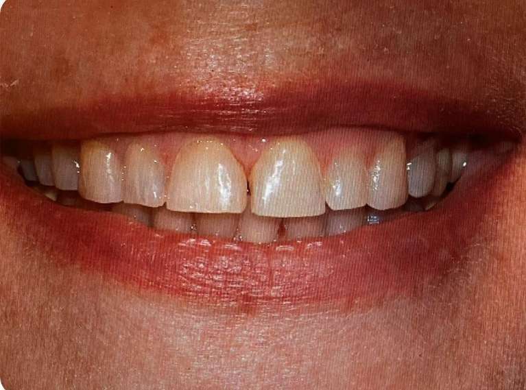 before porcelain veneers in huntsville, AL